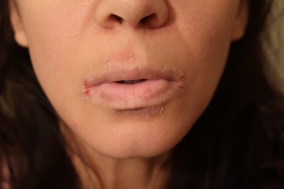 lichenified mouth from atopic dermatitis eczema dry lichenified mouth and lips bleeding at corners
