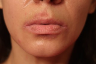 eczema atopic dermatitis on mouth moisturized with olive oil irritated mouth with eczema reaction rubbed with olive oil